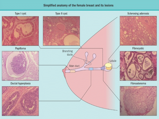 Figure 2 . Simplified anatomy of the female breast illustrating the major structural components of the breast, the anatomic location of various lesions, and the histology of those lesions and corresponding sites of origin of potential lesions.