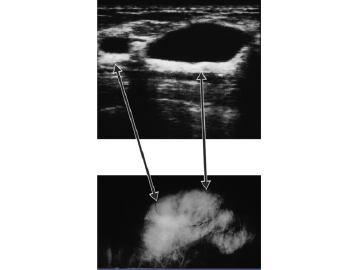 Figure 13 Upper panel illustrates by ultrasound a non-dense black area representing cyst fluid. The lower panel is the corresponding area on mammogram showing a dense area. With the combination of mammogram and ultrasound, the lesion can be shown to be a cyst. 