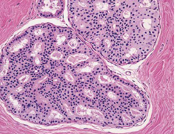 Figure 7. Photomicrograph of atypical ductal hyperplasia histology reprinted from Hartmann LC et al (23).