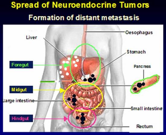 Tumor neuroendocrino páncreas esperanza de vida