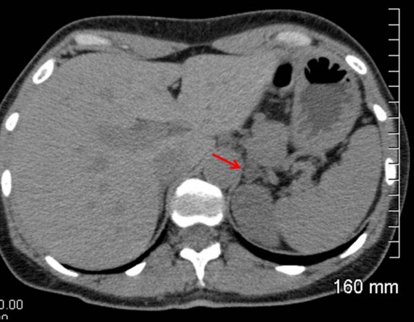 A CT scan with intravenous contrast was performed and revealed an 8 mm left adrenal mass. The density of this mass was 10 HU, and it displayed >50% washout of contrast following 10 minute delay.
