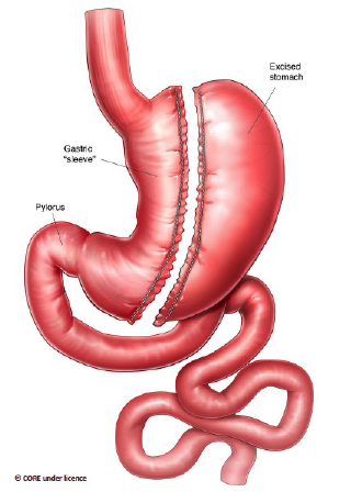 Figure 1. Sleeve gastrectomy