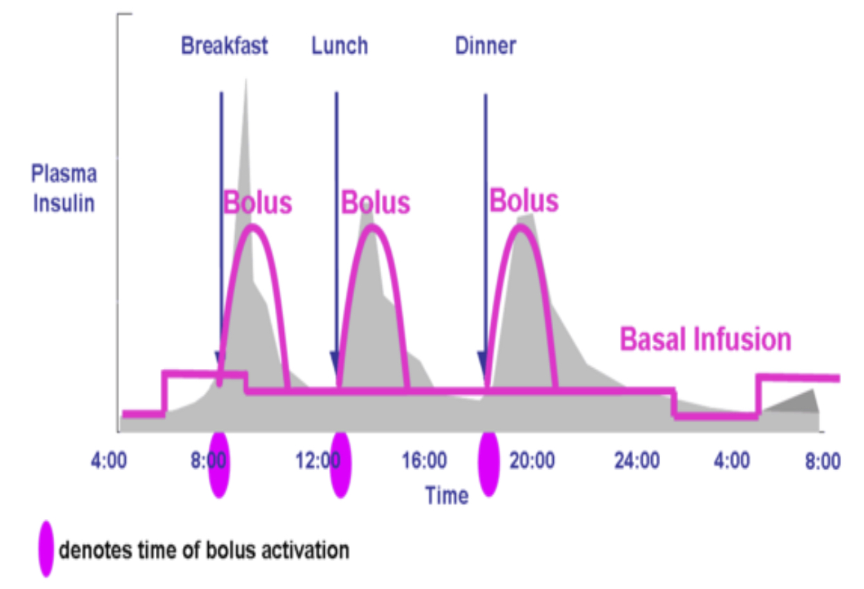 Figure 12: Idealized insulin curves for CSII with either insulin lispro, insulin aspart, or insulin glulisine. Note the basal insulin component can be altered based on changing basal insulin requirements. Typically, insulin rates need to be lowered between midnight and 0400 h (predawn phenomenon) and raised between 0400 h and 0800 h (dawn phenomenon). The basal rate the rest of the day is usually intermediate to the other two. Modern-day pumps can calculate prandial insulin dose by the patient entering into the pump the blood glucose concentration and the anticipated amount of carbohydrate to be consumed. The pump calculates how much previous prandial insulin is still active, and provides the patient a final suggested dose which the patient may activate or override.