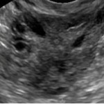 Figure 3: Ovarian sonographic imaging of women in their mid-30’s. Figure 3a is from a woman with premature ovarian failure and there are no visualized antral follicles (the sonographically anechoic regions measuring approximately two to nine millimeters within the ovary). Figure 3b is from a woman with tubal factor infertility, and for whom seeing a few follicles within a single plane of the ovary would be normal. Figure 3c is from a woman with polycystic ovarian syndrome. Though her ovary is arguably more multicystic than polycystic (which would typically have follicles concentrated on the periphery of the ovary), she met the criteria for PCOS and her ovary is clearly distinct from those shown in 3a and 3b. Of note, all three ultimately conceived with their own oocytes, so it should be remembered that the absence of visualized antral follicles makes conception far less probable, but not impossible.