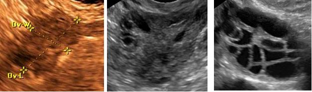 Figure 3: Ovarian sonographic imaging of women in their mid-30’s. Figure 3a is from a woman with premature ovarian failure and there are no visualized antral follicles (the sonographically anechoic regions measuring approximately two to nine millimeters within the ovary). Figure 3b is from a woman with tubal factor infertility, and for whom seeing a few follicles within a single plane of the ovary would be normal. Figure 3c is from a woman with polycystic ovarian syndrome. Though her ovary is arguably more multicystic than polycystic (which would typically have follicles concentrated on the periphery of the ovary), she met the criteria for PCOS and her ovary is clearly distinct from those shown in 3a and 3b. Of note, all three ultimately conceived with their own oocytes, so it should be remembered that the absence of visualized antral follicles makes conception far less probable, but not impossible.