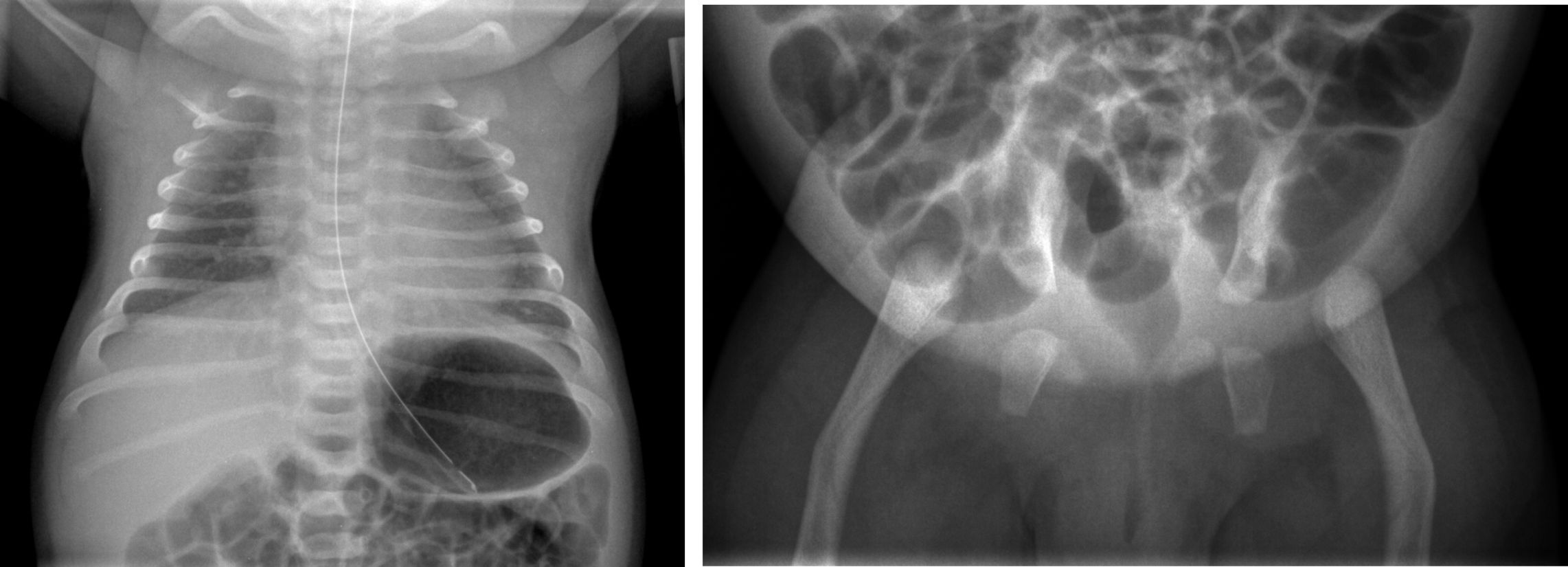 Figure 12. Campomelic dysplasia. bell-shaped thorax, hypoplastic scapula, bowed femurs, widely-spaced ischial bones.