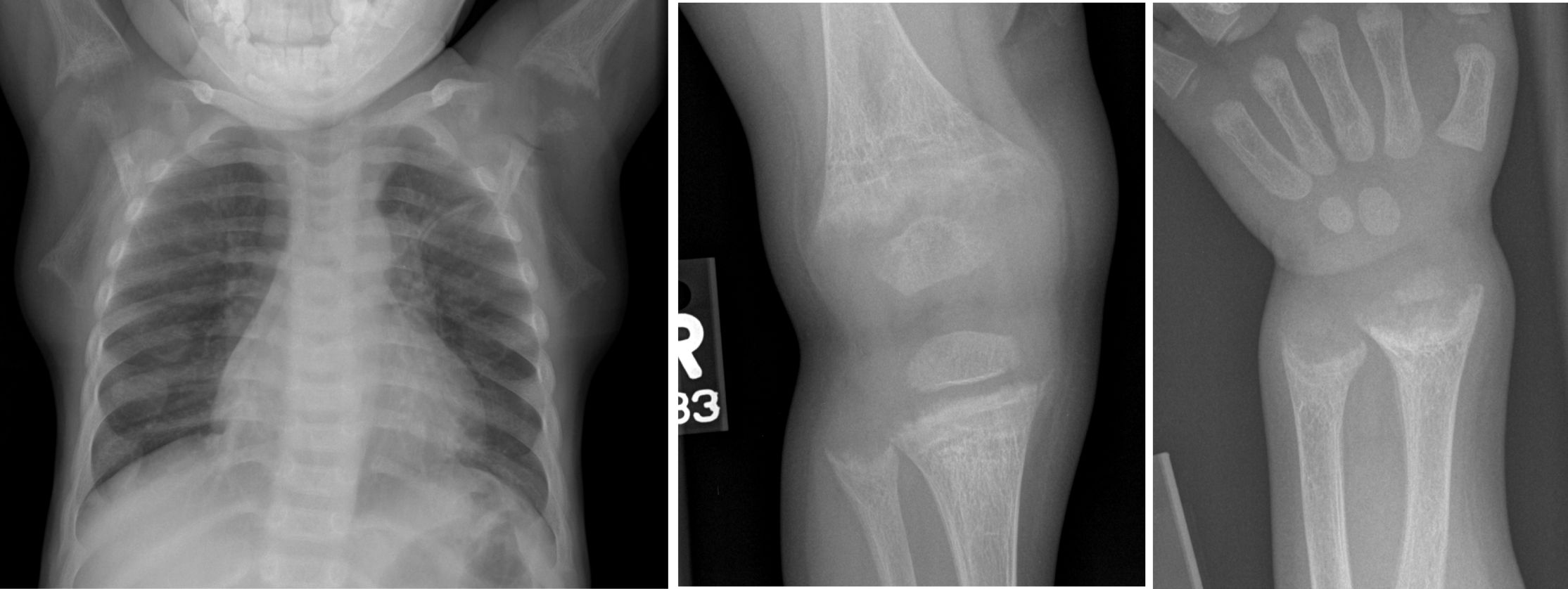 Figure 16. rickets. widened growth plates, cupping fraying of metaphyses, demineralization , widened anterior rib ends.