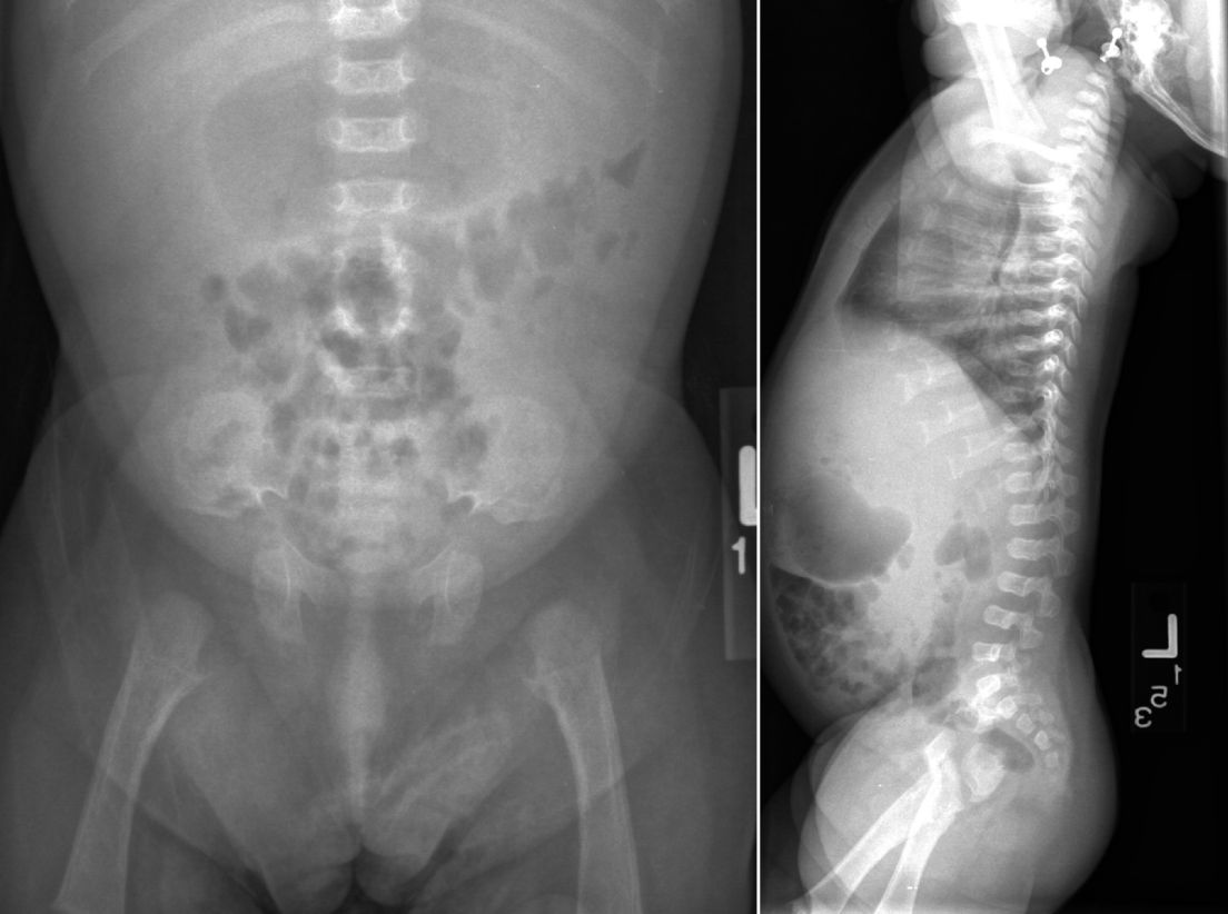 Figure 2. Achondroplasia. Small rounded iliac bones, horizontal acetabula, decreasing interpediculate distance, normal vertebral body height, short ribs.