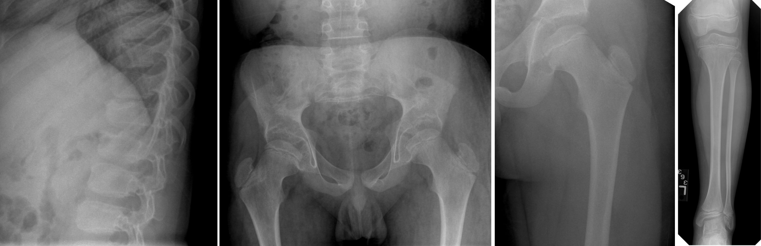 Figure 4. Stickler syndrome. small epiphyses, wide femoral neck, hypoplastic iliac wings, flat epiphyses, schmorl’s nodules.