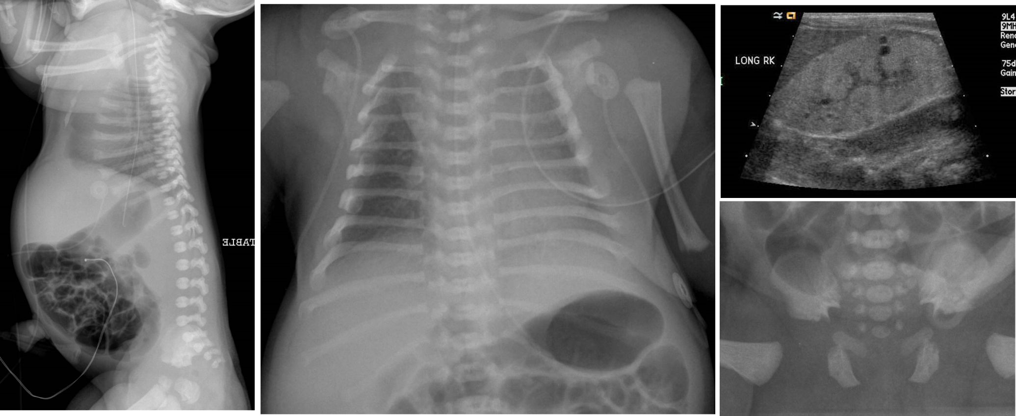 Figure 6. asphyxiating thoracic dystrophy. short ribs long and narrow chest, small pelvis, trident acetabula, no platyspondyly (helps differentiate from thanatophoric dysplasia), cystic renal disease.