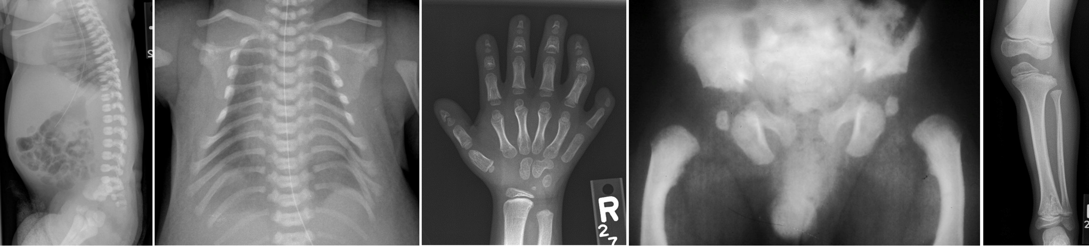 Figure 7. chondroectodermal dysplasia (or Ellis-van Creveld syndrome). short ribs, early ossification of femoral head, polydactyly cone-shaped epiphyses, no platyspondyly (helps differentiate from thanatophoric dysplasia), flatening of lateral aspect of proximal tibial epiphysis.