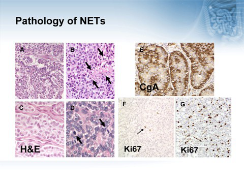 histological findings supporting the neuroendocrine nature of the tumor