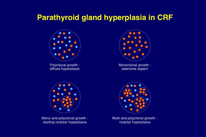 Figure 13. Schematic representation of the different types of parathyroid hyperplasia encountered in CKD patients with secondary uremic hyperparathyroidism.