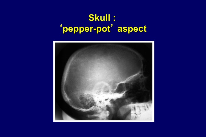 Figure 16. Pepper-and-salt aspect of the skull in in a chronic hemodialysis patient with severe secondary hyperparathyroidism.