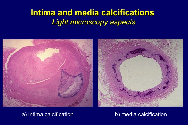 Figure 17. Massive intima (a) and media (b) calcification of hypogastric artery from a chronic hemodialysis patient.