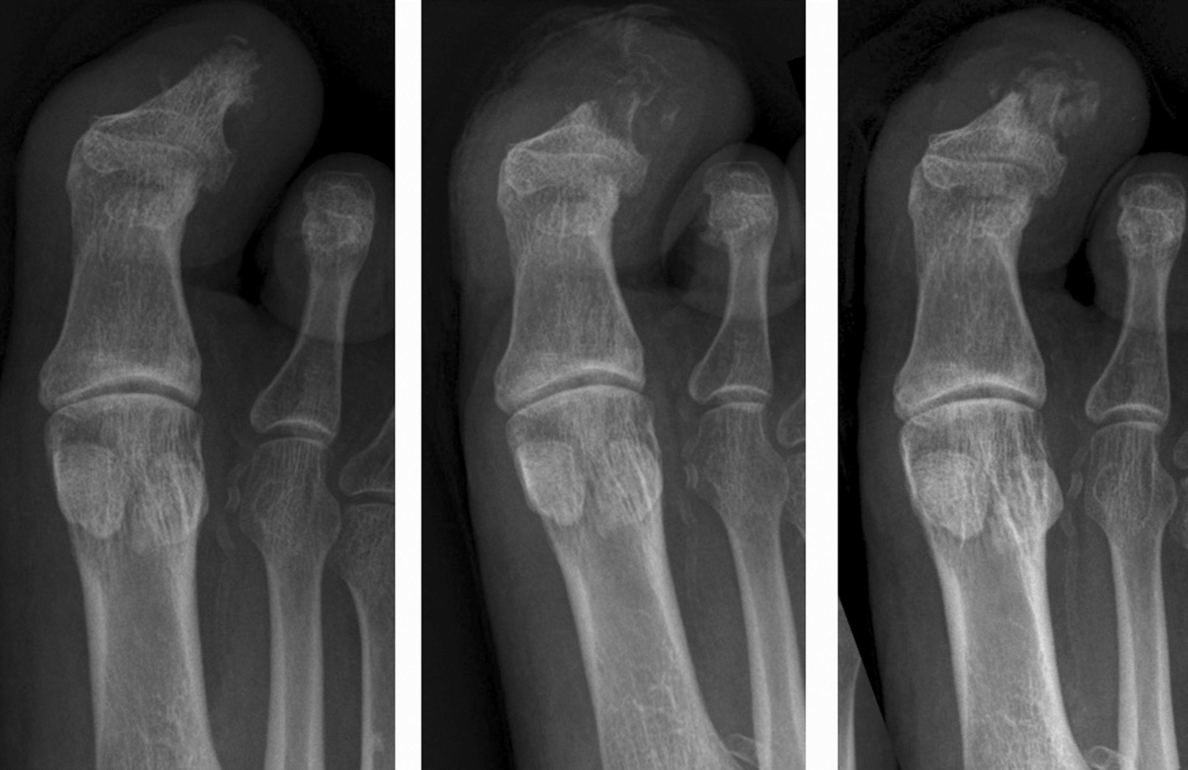 Figure 3. Acute presentation with an ulcer at the tip of the great toe, probing to bone. The terminal phalangeal tuft does show some irregularity (left panel). b) two weeks later there is marked bone demineralisation consistent with osteomyelitis (middle panel). C) After 2 months of treatment there has been partial remineralisation of the bone but with an underlying pathological fracture (right panel).