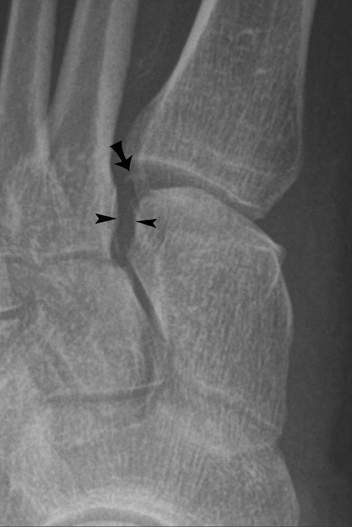 Figure 4. Acute Charcot’s neuroarthropathy. There is widening of the interosseous distance between the medial cuneiform and 2nd metatarsal (arrowheads), indicating disruption of the Lis-Franc ligament and a subtle flake fracture fragment (arrow).