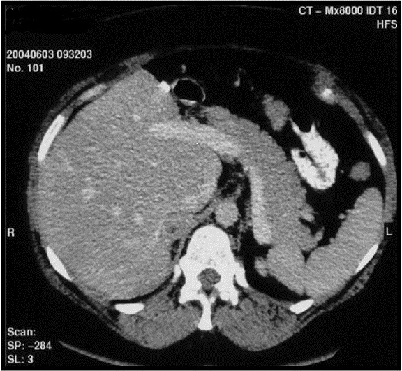 Figure 4a. Computed tomography showing recurrence of a right adrenal pheochromocytoma.