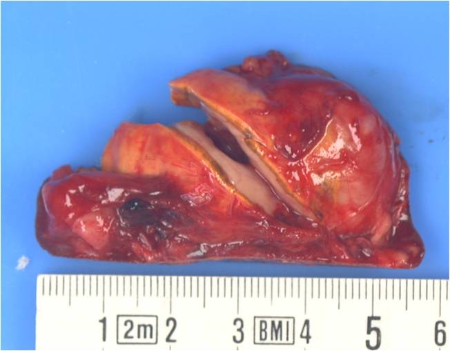 Figure 4b. Macroscopic photo of a right adrenal pheochromocytoma removed from the above patient with multiple endocrine neoplasia type 2