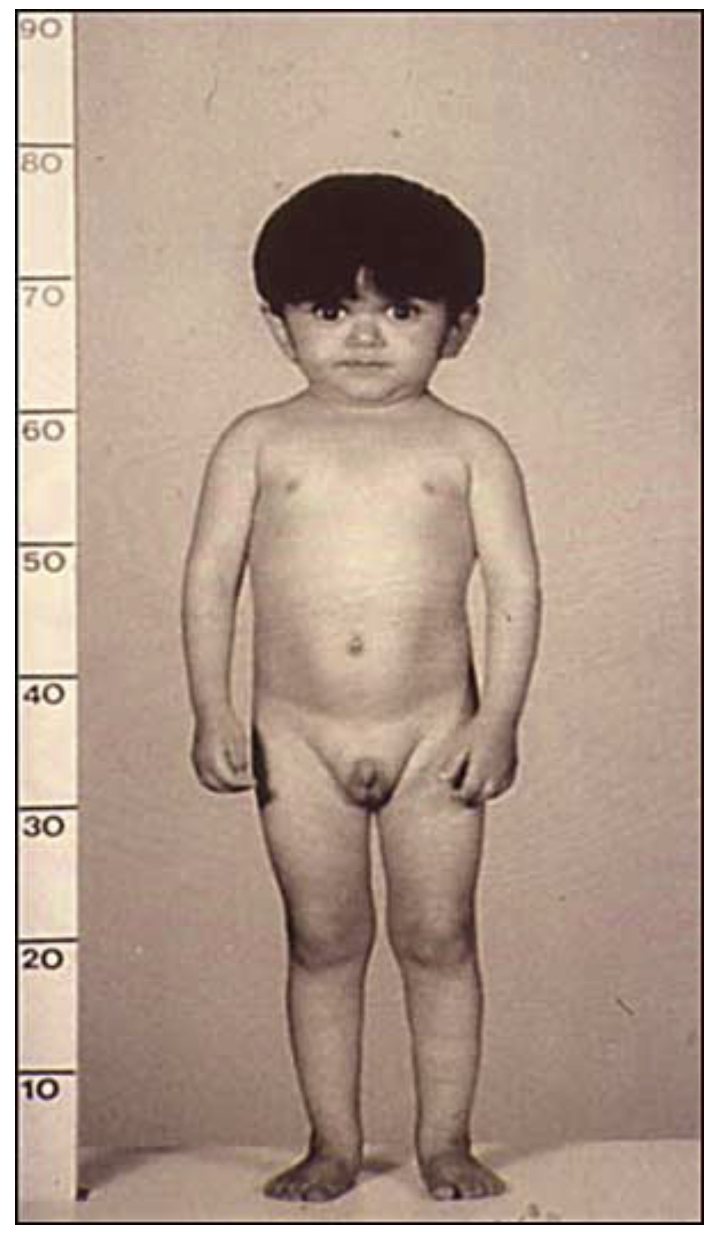 Figure 4 – Child with Laron syndrome. Short stature with typical facial appearance of GH insensitivity with midface hypoplasia, this finding is common to GH deficiency as well.