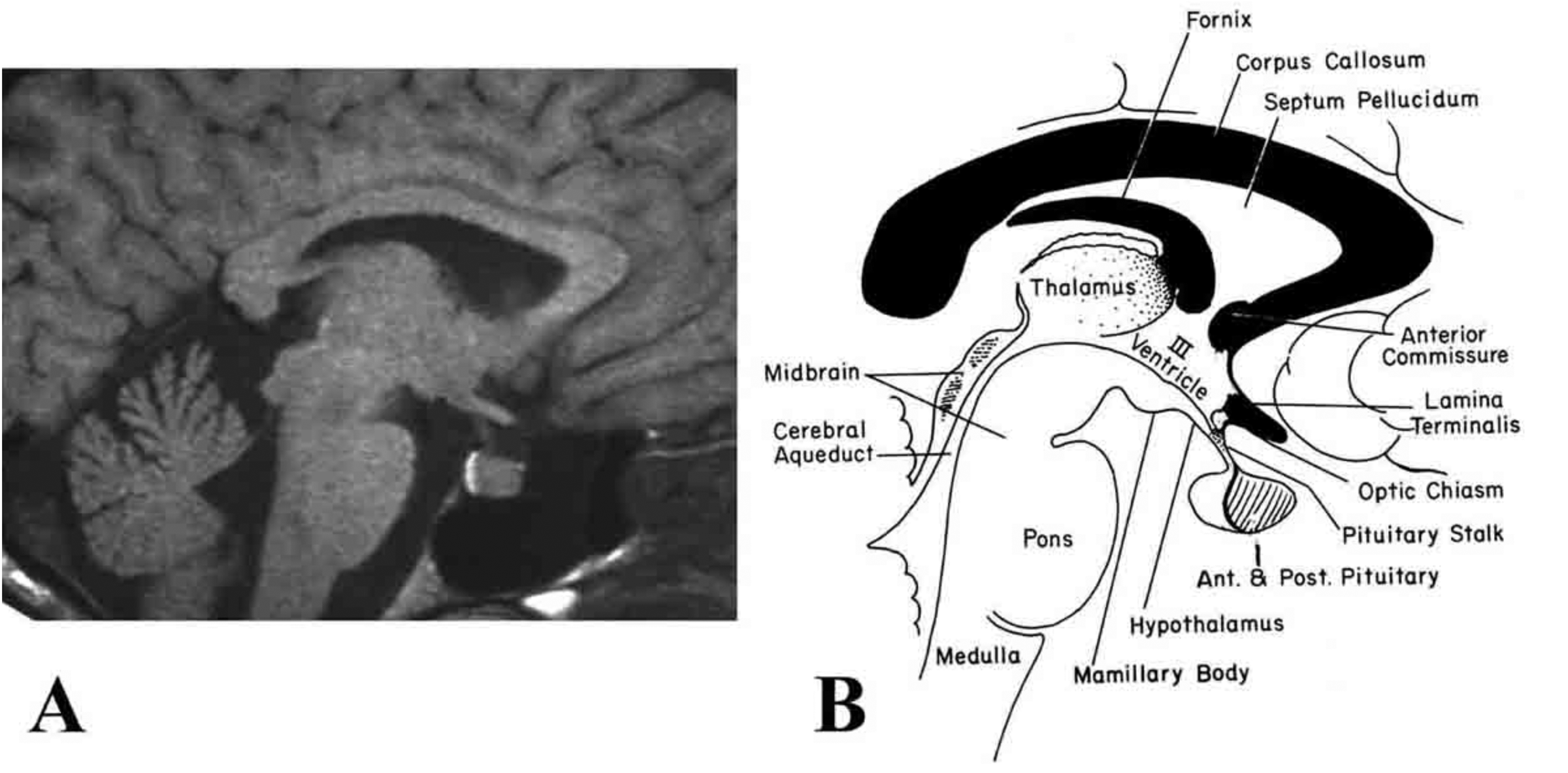Fig. 6. (A) Magnetic resonance image (MRI) and (B) corresponding schematic illustration of the human hypothalamus (H) and pituitary gland seen in saggital orientation. Note the high intensity or "bright spot" of the posterior pituitary by MRI in (A), sharply defining the boundary between the anterior pituitary gland. III = third ventricle (Modified from Lechan RM. Neuroendocrinology of Pituitary Hormone Regulation. Endocrinology and Metabolism Clinics 16:475-501, 1987.)