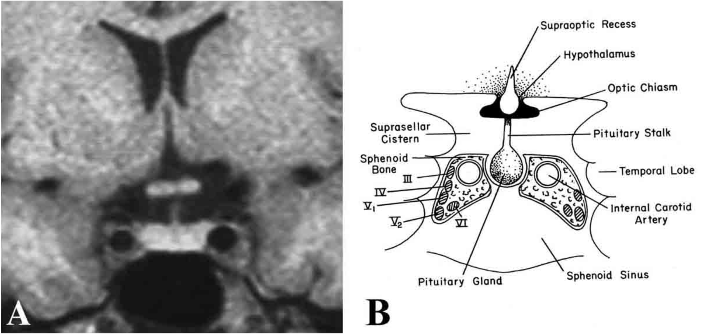 Fig. 7. (A) MRI and (B) schematic image of the pituitary fossa and its anatomic relationships seen in coronal orientation. The cavernous sinus contains the internal carotid artery and cranial nerves III, IV, V1, V2, and VI. The optic chiasm resides immediately above the pituitary gland and is separated from it by a cerebrospinal fluid-filled cistern. (Modified from Lechan RM. Neuroendocrinology of Pituitary Hormone