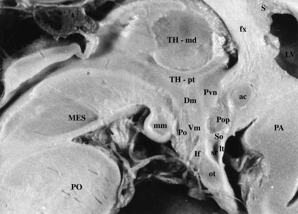 Fig. 12. Magnified view of a fixed human brain in midsagittal orientation. The third ventricle makes up the core of the hypothalamus and extends into the pituitary (or infundibular) stalk, creating the infundibular recess. Many of the major cell groups are located near the midline. These include (from rostral to caudal) the preoptic nucleus (Pop), paraventricular nucleus (Pvn), dorsomedial nucleus (Dm), ventromedial nucleus (Vm), arcuate (or infundibular) nucleus (If), posterior hypothalamic nucleus (Po), and medial mammillary nucleus (mm). Ac = anterior commissure, fx = fornix, lt= lamina terminalis, ot = optic tract and chiasm, Lv = lateral ventricle, MB = midbrain, PN = pons, Sr = supraoptic recess, T = thalamus. (From Lechan R.M. and Toni R., Regulation of Pituitary Function, in Korenman S.G (Ed), Atlas of Clinical Endocrinology, Current Medicine, vol IV, 1-25, 2000).