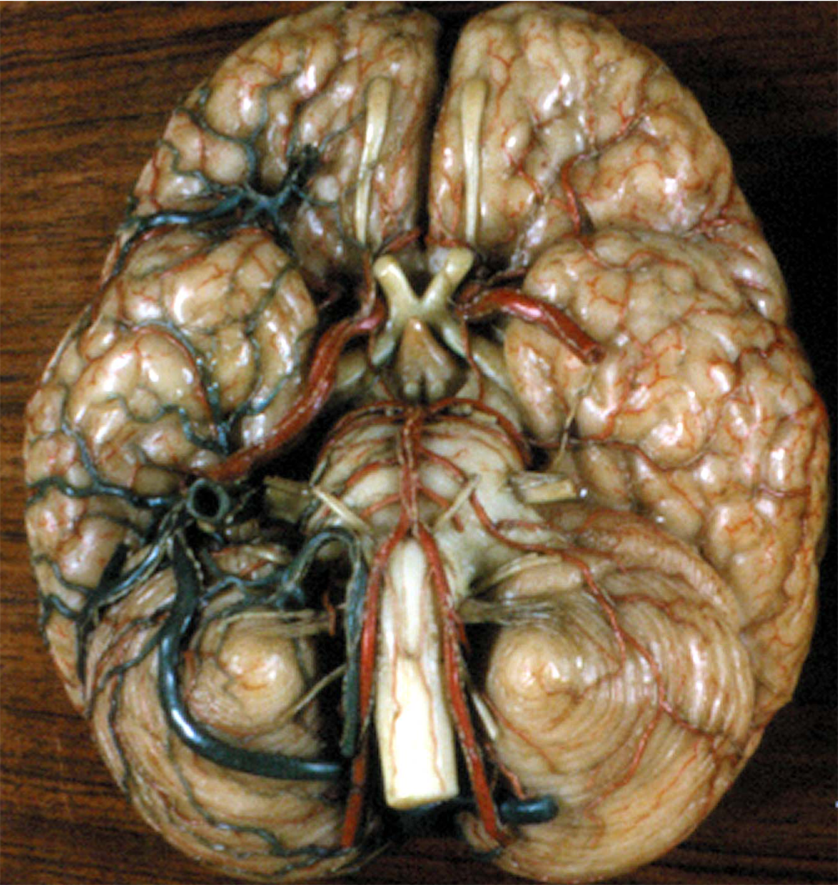 Fig. 14. Basal view of the brain showing the external surface of the floor of the hypothalamus and its arterial vessels. The infundibulum (I) lies posteriorly to the optic tracts and chiasm (ot) and anterior to the mammillary bodies (m). The arterial circle of Willis surrounds the hypothalamic floor and provides the arterial supply to the hypothalamic nuclei and fiber tracts. ac = anterior cerebral artery, aco = anterior communicating artery, b = basilar artery, ic = internal carotid artery, P = pons, pc = posterior cerebral artery, pco = posterior communicating artery. (From the XIX century wax collection of human brains at the Museum of the Department of Human Anatomy of the University of Bologna, Italy.)