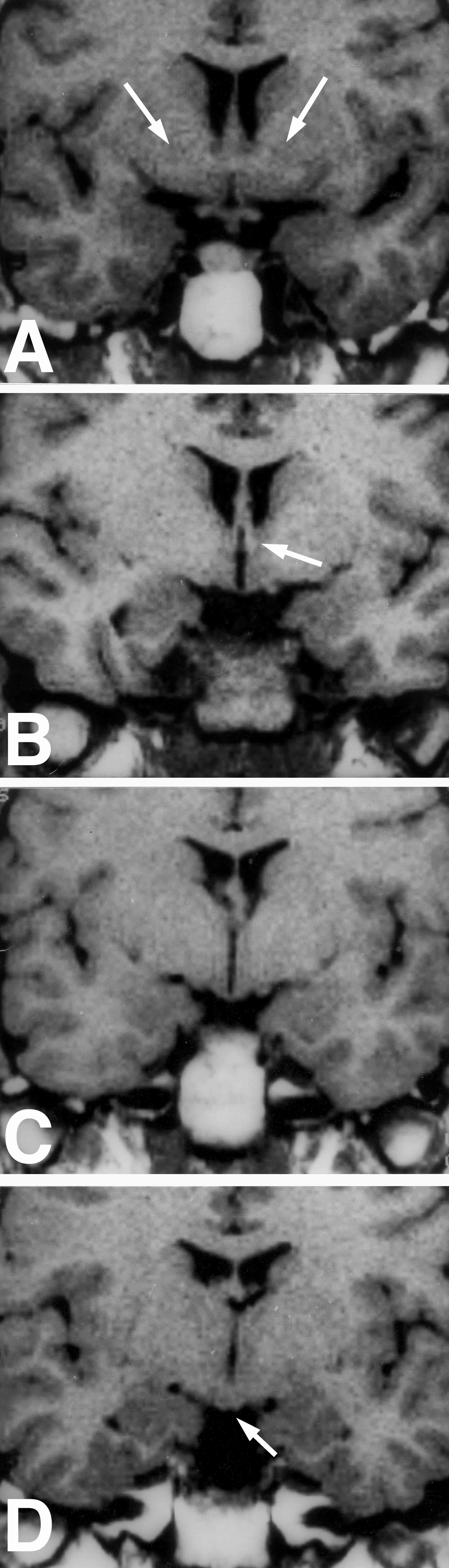 Fig. 27. MRI of coronal sections through the hypothalamus. (A) Anterior hypothalamus corresponding to Fig. 17A showing location of the anterior commissure (arrows). (B) Mid hypothalamus corresponding to Fig. 17B showing location of the fornix (arrow). (C) Mid hypothalamus corresponding to Fig. 17C showing the optic tract. The fornix can sometimes also be visualized at this level. (D) Caudal hypothalamus corresponding to Fig. 17D at the level of the medial mammillary bodies (arrow). Sometimes the mammilothalamic tract can be visualized at this level.