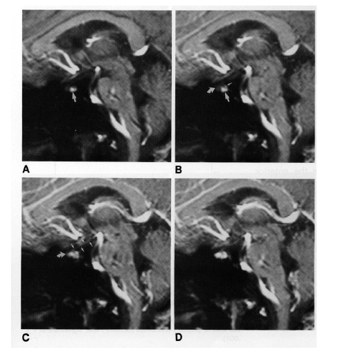 Fig. 10. (A-D) MRI of sequential sequences of the stalk and pituitary gland in saggital orientation following the intravenous administration of gadolineum. (A) Appearance prior to gadolineum. (B) Following gadolineum, the posterior pituitary is the first structure to show contrast enhancement. (C) This is followed by the pituitary stalk (arrow) and then finally (D) the anterior pituitary. (From Yuh et al, AJNR 15: 101-108, 1994.)