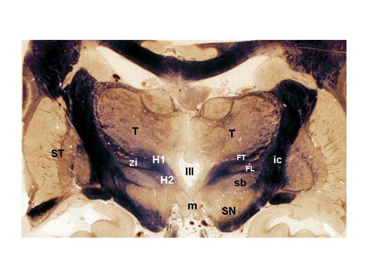 Fig. 13. Coronal section of a fixed human brain at the level of the posterior hypothalamus. The third ventricle (III) lies in the midline directly above the mammillary bodies (m). The subthalamus (sb), zona incerta (zi) and thalamus (T) are located at the superior border of the hypothalamus, whereas the corpus striatum (ST) is located laterally. FL = fasciculus lenticularis, FT = fasciculus thalamicus, ic = internal capsule, SN = substantia nigra, H1 = field H1 of Forel; H2 = field H2 of Forel. (From Toni R, Malaguti A, Benfenati F, Martini L: The human hypothalamus: a morphofunctional perspective. J Endocrinol Invest 27 (supp to n.6), 73-94, 2004.)