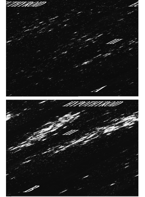 Fig. 32. High magnification in situ hybridization autoradiographs of proTRH mRNA in the paraventricular nucleus (PVN) of a (A) euthyroid and (B) hypothyroid animal. Note marked increase in TRH mRNA when circulating levels of thyroid hormone fall. Low magnification in situ hybridization autoradiographs of proTRH mRNA in the PVN of (C) normal fed and (D) fasting animals. Hybridization signal is markedly reduced in the fasting animals despite low circulating levels of thyroid hormone.