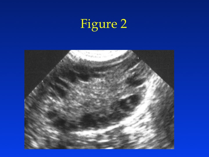 Figure 2: Transvaginal ultrasound of a polycystic ovary. Note the increased number of antral follicles ringing the outside of the ovary and the increased central stroma.