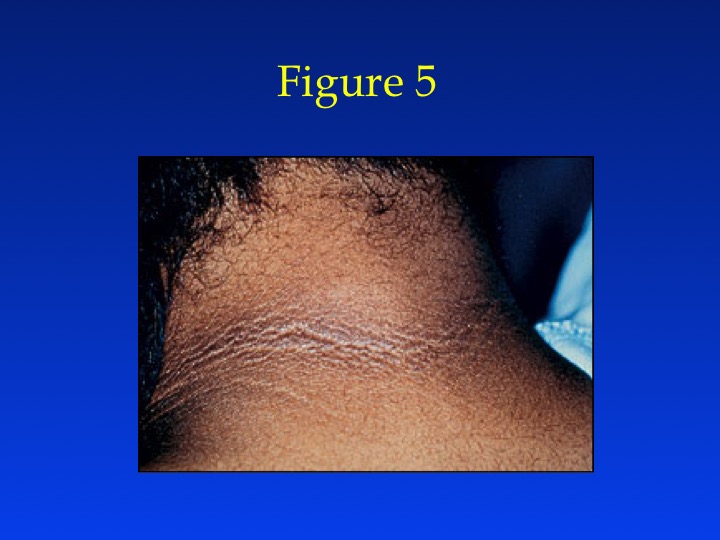 Figure 5: Acanthosis nigricans on the nape of the neck in a woman with PCOS.