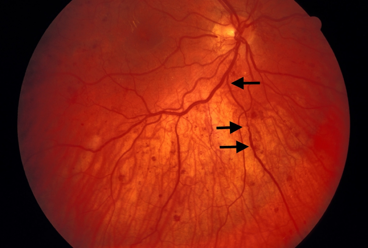 Диабетическая ретинопатия глазное дно. Пролиферативная диабетическая ретинопатия. Гипертоническая ангиопатия и ретинопатия. Ангиопатия сосудов сетчатки что это