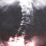 Figure 1. Standard radiograph of abdomen showing opaque kidney stone in the parenchyma of the left kidney. This stone may be asymptomatic or may cause pain, hematuria, infection.