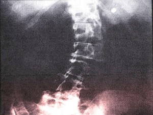 Figure 1. Standard radiograph of abdomen showing opaque kidney stone in the parenchyma of the left kidney. This stone may be asymptomatic or may cause pain, hematuria, infection.