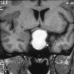 Figure 1a. Resonance Imaging T1-weighted sequences on coronal planes. Intra- and suprasellar craniopharyngioma in a 8 yr old boy presenting with reduced growth velocity and headache. This tumor has a total cystic component as shown by the hyper-intense spontaneous signal. (Kindly provided by S. Cirillo, II University of Naples).