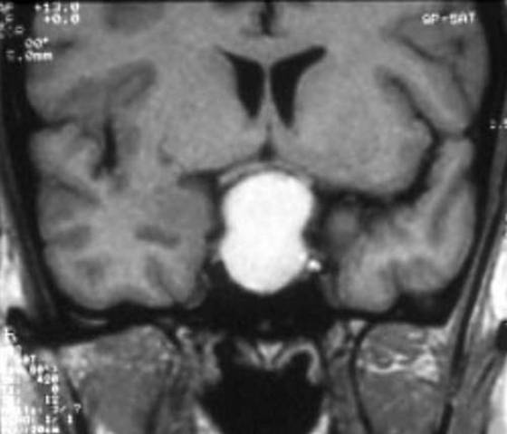 Figure 1a. Resonance Imaging T1-weighted sequences on coronal planes. Intra- and suprasellar craniopharyngioma in a 8 yr old boy presenting with reduced growth velocity and headache. This tumor has a total cystic component as shown by the hyper-intense spontaneous signal. (Kindly provided by S. Cirillo, II University of Naples).